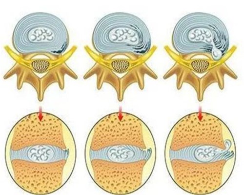 脊柱退變_脊柱退變治療-產(chǎn)品列表頁-盤錦骨科醫(yī)院