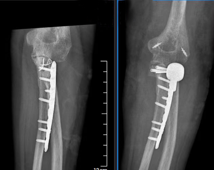 意外摔成肘關節&ldquo;恐怖三聯征&rdquo;重慶長城骨科醫院專家團隊妙手解病痛