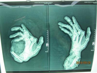 廣州阿伯右手卷入機器&ldquo;骨肉分離&rdquo;,醫生11小時幫他接回手臂